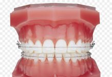 Брекеты: плюсы и особенности