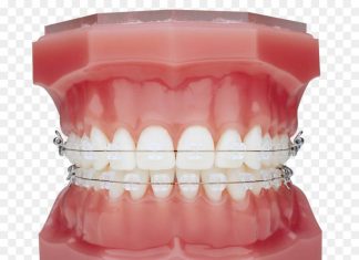 Брекеты: плюсы и особенности