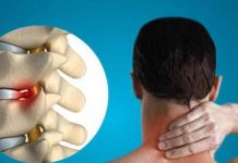 Симптомы грыжи шейного отдела