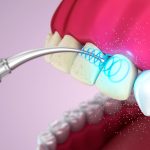 Для чего нужна чистка зубного камня