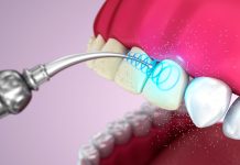 Для чего нужна чистка зубного камня