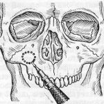 Как проводят гайморотомию
