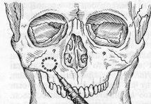 Как проводят гайморотомию
