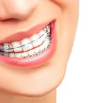Керамические брекеты: плюсы и минусы