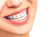Керамические брекеты: плюсы и минусы