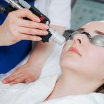 Как проходит процедура лазерной эпиляции над верхней губой