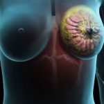 Как лечится рак груди