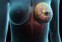 Как лечится рак груди