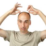 В каких случаях необходима пересадка волос мужчинам