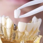 Больно ли ставить коронку на зуб?