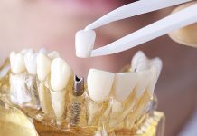 Больно ли ставить коронку на зуб?