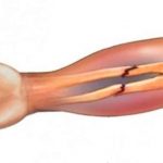 Как отличить перелом от других видом травм