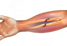 Как отличить перелом от других видом травм