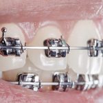 Как выбрать брекеты