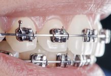 Как выбрать брекеты