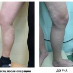 Врач флеболог и его специализация