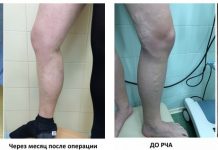 Врач флеболог и его специализация