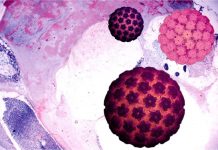 Что такое папилломатоз гортани и как его лечить?