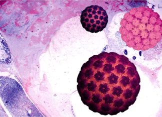 Что такое папилломатоз гортани и как его лечить?