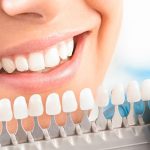 Виды и принципы отбеливания зубов