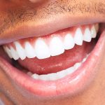 Как происходит установка имплантов