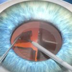 Что такое катаракта и как её лечить