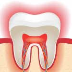 Лечение корней зубов