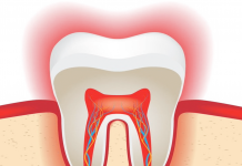 Лечение корней зубов