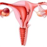 Что такое эндометриоз у женщин