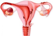 Что такое эндометриоз у женщин