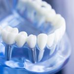 Что такое протезирование и как оно проводится