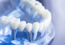 Что такое протезирование и как оно проводится