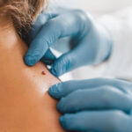 Что такое рак кожи и как его лечить