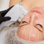 Особенности ультразвукового SMAS-лифтинга