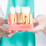 Из чего формируется цена на имплантаты зубов