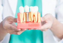 Из чего формируется цена на имплантаты зубов