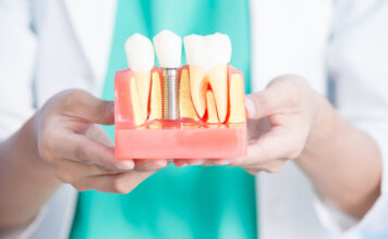 Из чего формируется цена на имплантаты зубов