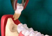 Почему удаляют зубы мудрости