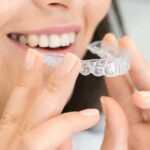 Что такое элайнеры и в чем их преимущества