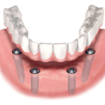 Что такое несъемное протезирование зубов