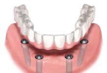 Что такое несъемное протезирование зубов