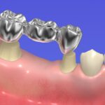 Что такое мостовидные протезы