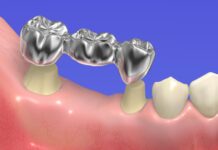 Что такое мостовидные протезы