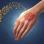 Что такое псориаз и как его лечить