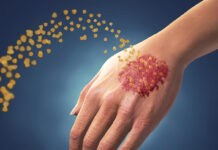 Что такое псориаз и как его лечить