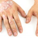 Что такое псориаз и чем он опасен