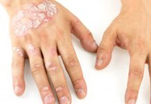 Что такое псориаз и чем он опасен