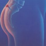 Что такое эпителиальный копчиковый ход?