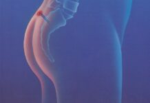 Что такое эпителиальный копчиковый ход?