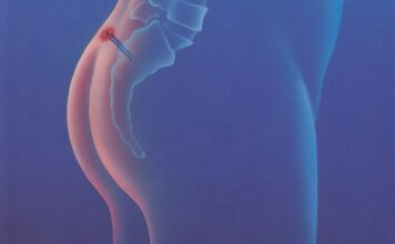 Что такое эпителиальный копчиковый ход?